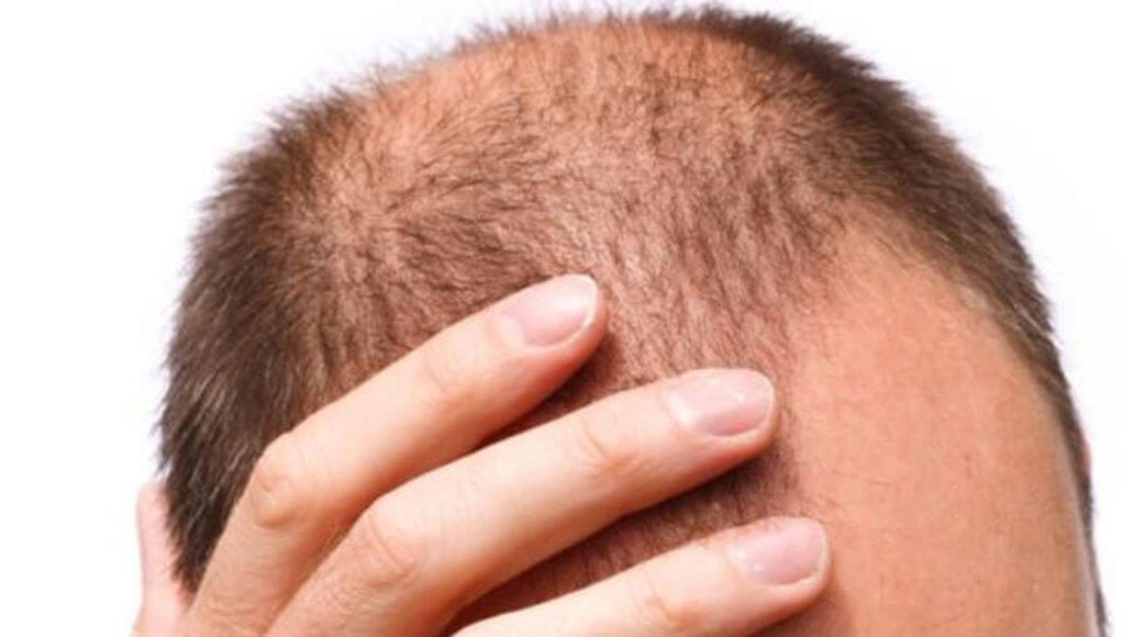 Bald men at higher risk of Coronavirus infection