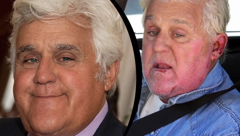 Jay Leno reveals a "new face" after an accident