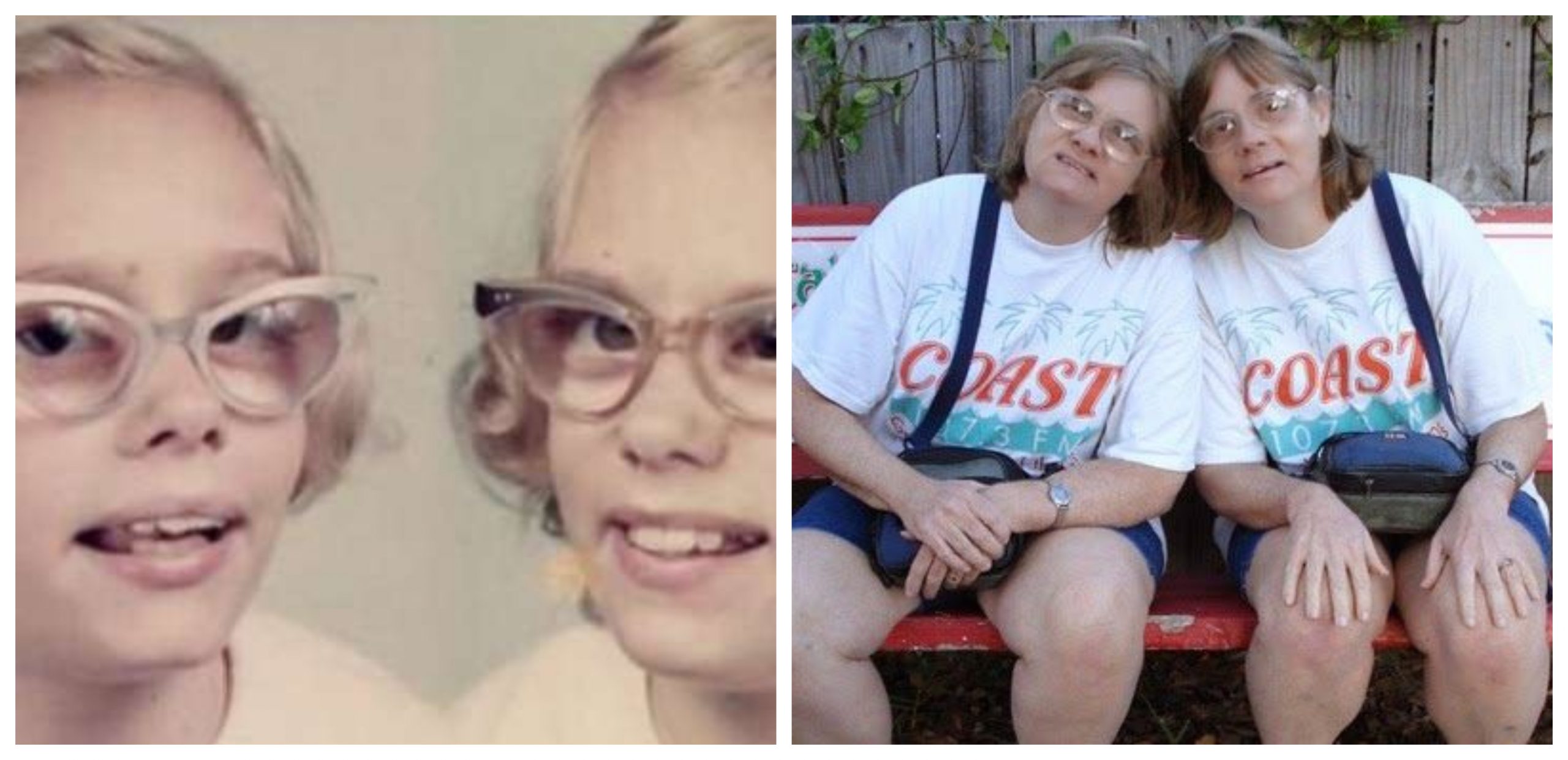 The Incredible Lives of the Only Lyman Twins - Lonely Childhood, Genius and Unexpected Fame